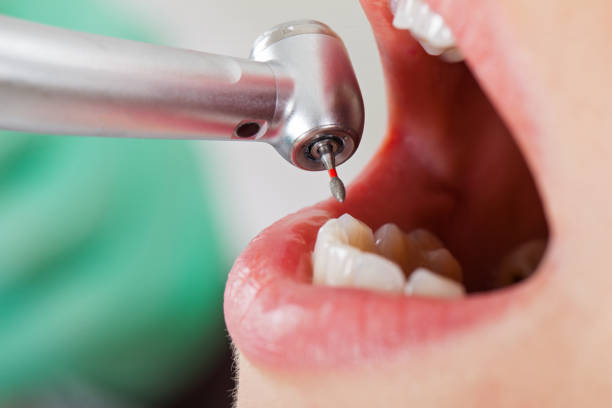 Best Emergency Tooth Extraction in Fort Washakie, WY